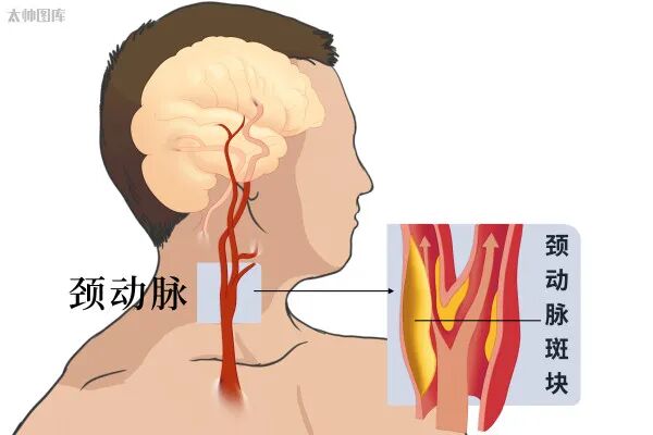 『附一医讯』国际前沿手术落地！福医附一医院血管外科成功完成三例逆血流保护装置下经颈动脉支架成形术（TCAR）
