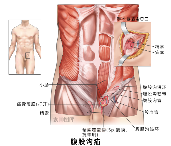 『附一科普』大腿根鼓个包？别慌！腹股沟疝这样应对
