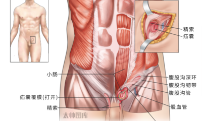 『附一科普』大腿根鼓个包？别慌！腹股沟疝这样应对