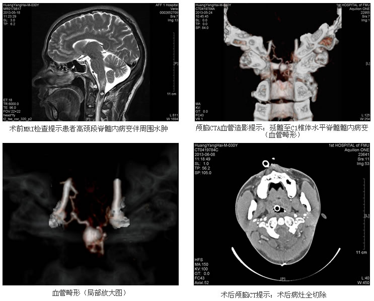 年青小伙突发顽疾难确诊 神经外科专家妙手解危难——我院成功为高颈段脊髓内血管畸形患者实施显微精准手术