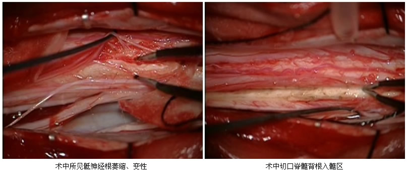 我院神经外科疼痛外科专业组开展脊髓背根入髓区切开术治疗癌性神经病理性疼痛 我院神经外科疼痛外科专业组开展脊髓背根入髓区切开术治疗癌性神经病理性疼痛