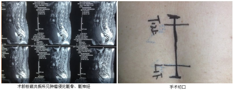 我院神经外科疼痛外科专业组开展脊髓背根入髓区切开术治疗癌性神经病理性疼痛 我院神经外科疼痛外科专业组开展脊髓背根入髓区切开术治疗癌性神经病理性疼痛