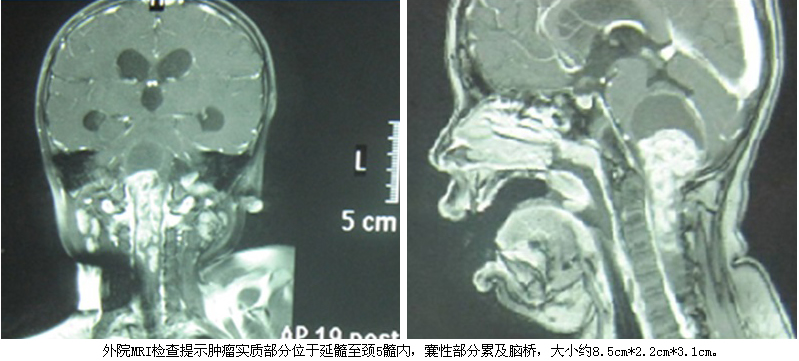 我院神经外科与麻醉科精诚合作成功完成一例延髓高颈段巨大髓内肿瘤手术