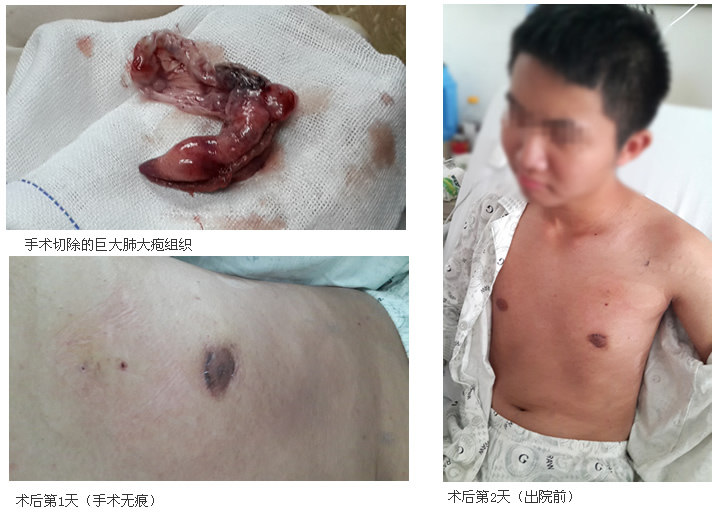 我院胸外科成功开展胸腔无痕手术治疗气胸 我院胸外科成功开展胸腔无痕手术治疗气胸