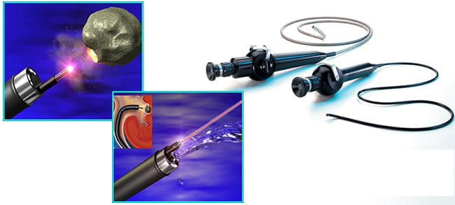 泌尿外科成功开展电子输尿管软镜碎石取石术 泌尿外科成功开展电子输尿管软镜碎石取石术