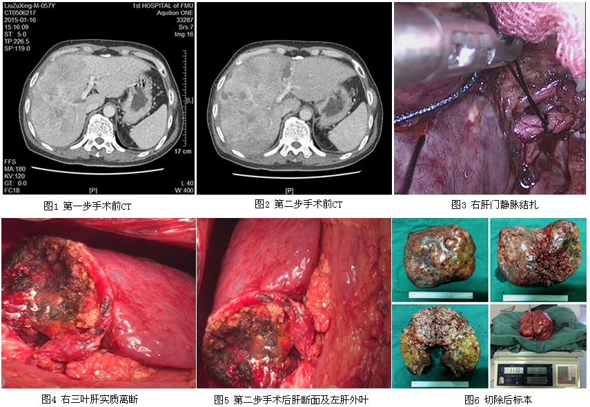 肝胆胰外科一区成功实施我院首例联合肝脏离断和门静脉结扎二步肝切除术 肝胆胰外科一区成功实施我院首例联合肝脏离断和门静脉结扎二步肝切除术