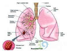 您了解肺部小结节性病变吗 您了解肺部小结节性病变吗