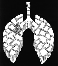 您了解肺部小结节性病变吗 您了解肺部小结节性病变吗