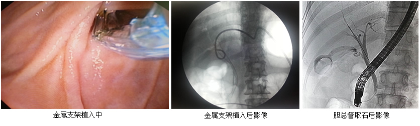 肝胆胰外科成功开展ERCP相关技术 肝胆胰外科成功开展ERCP相关技术
