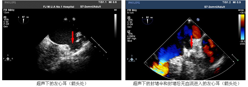 我院心血管内科一天成功完成3例房颤患者经皮左心耳封堵术 我院心血管内科一天成功完成3例房颤患者经皮左心耳封堵术
