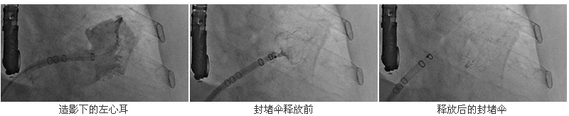 我院心血管内科一天成功完成3例房颤患者经皮左心耳封堵术 我院心血管内科一天成功完成3例房颤患者经皮左心耳封堵术