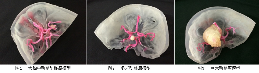 我院神经外科开创我国先例——应用3D打印颅内动脉瘤模型指导脑动脉瘤外科手术
