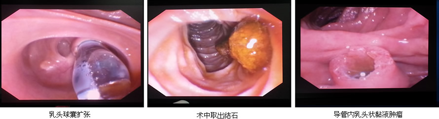 安全至上  用科研的态度对待每一例患者--肝胆胰外科ERCP开展突破50例