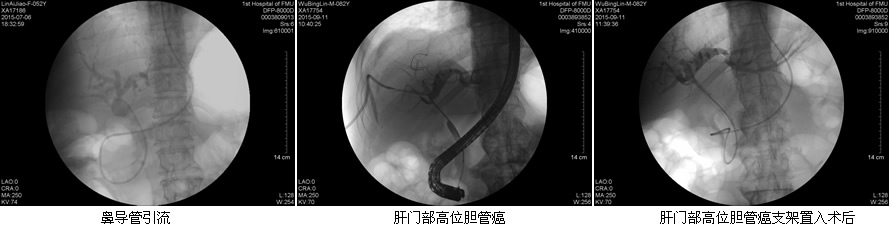 安全至上  用科研的态度对待每一例患者--肝胆胰外科ERCP开展突破50例
