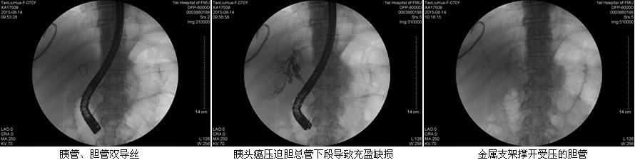 安全至上  用科研的态度对待每一例患者--肝胆胰外科ERCP开展突破50例