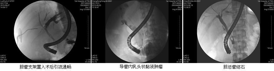 安全至上  用科研的态度对待每一例患者--肝胆胰外科ERCP开展突破50例