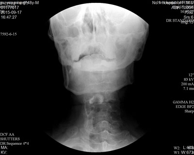 康复科成功开展吞咽造影录像检查与评估相关技术