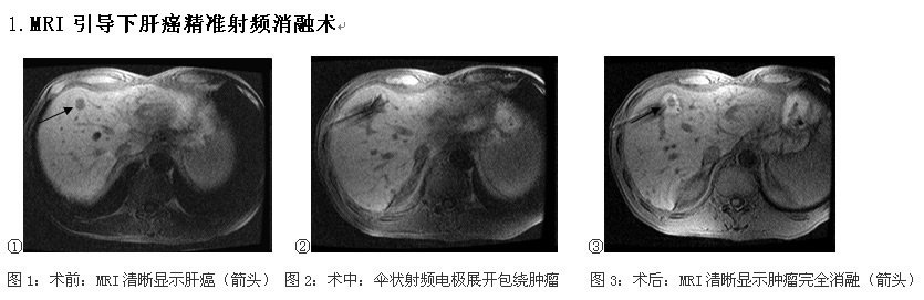 前进中的福建医科大学附属第一医院介入科 前进中的福建医科大学附属第一医院介入科