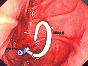 我院肝胆胰外科成功开展多例胃毕-Ⅱ式术后ERCP 我院肝胆胰外科成功开展多例胃毕-Ⅱ式术后ERCP