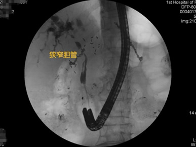 我院肝胆胰外科成功开展多例胃毕-Ⅱ式术后ERCP 我院肝胆胰外科成功开展多例胃毕-Ⅱ式术后ERCP