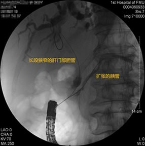 我院肝胆胰外科成功开展多例胃毕-Ⅱ式术后ERCP 我院肝胆胰外科成功开展多例胃毕-Ⅱ式术后ERCP