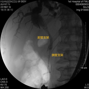 我院肝胆胰外科成功开展多例胃毕-Ⅱ式术后ERCP 我院肝胆胰外科成功开展多例胃毕-Ⅱ式术后ERCP