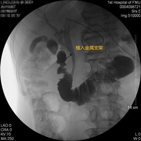 我院肝胆胰外科成功开展多例胃毕-Ⅱ式术后ERCP 我院肝胆胰外科成功开展多例胃毕-Ⅱ式术后ERCP