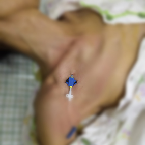 我院急诊科深静脉置管技术的“昨天、今天与明天” 我院急诊科深静脉置管技术的“昨天、今天与明天”