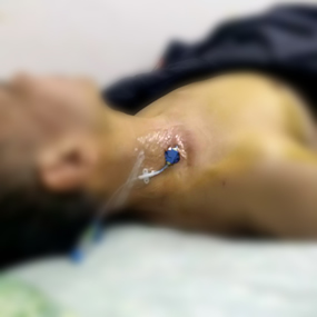 我院急诊科深静脉置管技术的“昨天、今天与明天” 我院急诊科深静脉置管技术的“昨天、今天与明天”