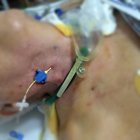 我院急诊科深静脉置管技术的“昨天、今天与明天” 我院急诊科深静脉置管技术的“昨天、今天与明天”