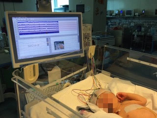 我院新生儿科开展床边脑电监护新技术