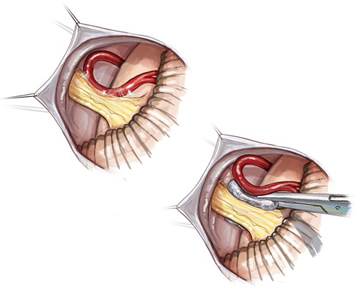 顽固性眩晕也能通过手术治疗？——我院完成省内首例微血管减压手术治疗难治性眩晕