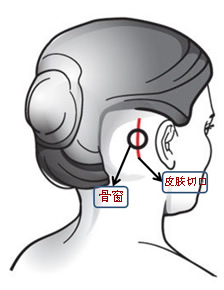 顽固性眩晕也能通过手术治疗？——我院完成省内首例微血管减压手术治疗难治性眩晕