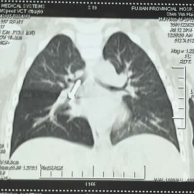 【媒体看附一】--4岁男娃吞下螺丝钉 卡在气管命悬一线 附一医院专家妙手摘除 【媒体看附一】--4岁男娃吞下螺丝钉 卡在气管命悬一线 附一医院专家妙手摘除