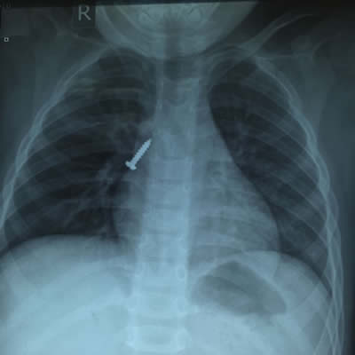 【媒体看附一】--4岁男娃吞下螺丝钉 卡在气管命悬一线 附一医院专家妙手摘除 【媒体看附一】--4岁男娃吞下螺丝钉 卡在气管命悬一线 附一医院专家妙手摘除