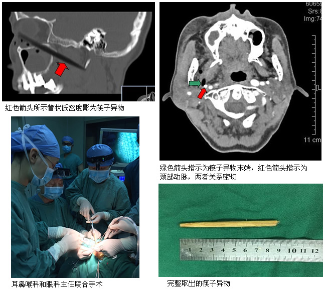 【媒体看附一】--罕见异物与血管近在咫尺 危难时刻有医生妙手除疴 【媒体看附一】--罕见异物与血管近在咫尺 危难时刻有医生妙手除疴
