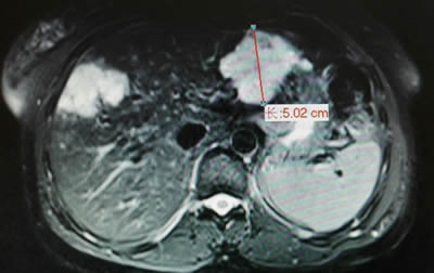 我院介入科开展肝血管瘤的微创介入治疗