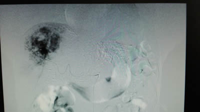 我院介入科开展肝血管瘤的微创介入治疗