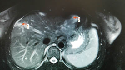 我院介入科开展肝血管瘤的微创介入治疗