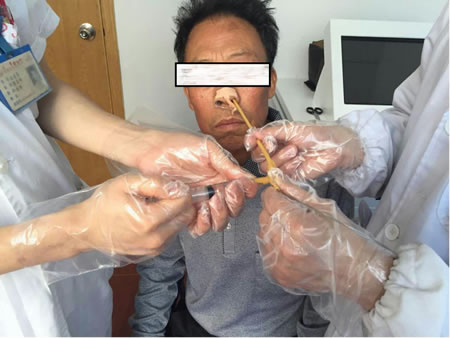 小小导尿管解决大问题——我院康复医学科采用导尿管球囊扩张技术成功为患者解除吞咽障碍