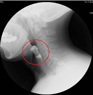 小小导尿管解决大问题——我院康复医学科采用导尿管球囊扩张技术成功为患者解除吞咽障碍