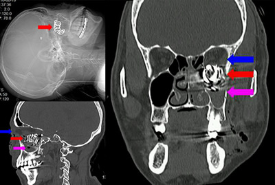 一声枪响弹簧扎入面中 两科协作异物取离眶鼻 一声枪响弹簧扎入面中 两科协作异物取离眶鼻