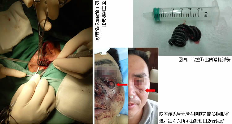 一声枪响弹簧扎入面中 两科协作异物取离眶鼻 一声枪响弹簧扎入面中 两科协作异物取离眶鼻