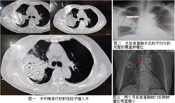 我院介入科成熟应用放射性粒子植入术为肺癌患者带来新曙光 我院介入科成熟应用放射性粒子植入术为肺癌患者带来新曙光