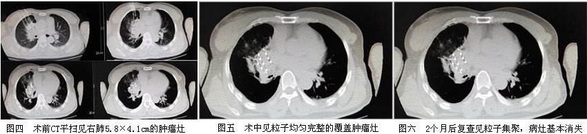 我院介入科成熟应用放射性粒子植入术为肺癌患者带来新曙光 我院介入科成熟应用放射性粒子植入术为肺癌患者带来新曙光