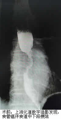 食道支架——解决食管癌患者进食难题 食道支架——解决食管癌患者进食难题