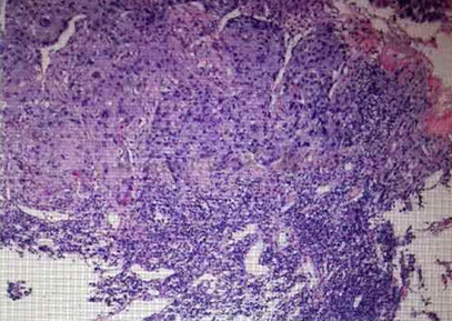 食道支架——解决食管癌患者进食难题 食道支架——解决食管癌患者进食难题