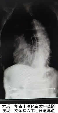 食道支架——解决食管癌患者进食难题 食道支架——解决食管癌患者进食难题