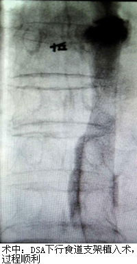 食道支架——解决食管癌患者进食难题 食道支架——解决食管癌患者进食难题
