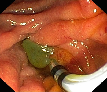 不负台胞信任——我院肝胆胰外科为其成功施行无X线下ERCP术 不负台胞信任——我院肝胆胰外科为其成功施行无X线下ERCP术
